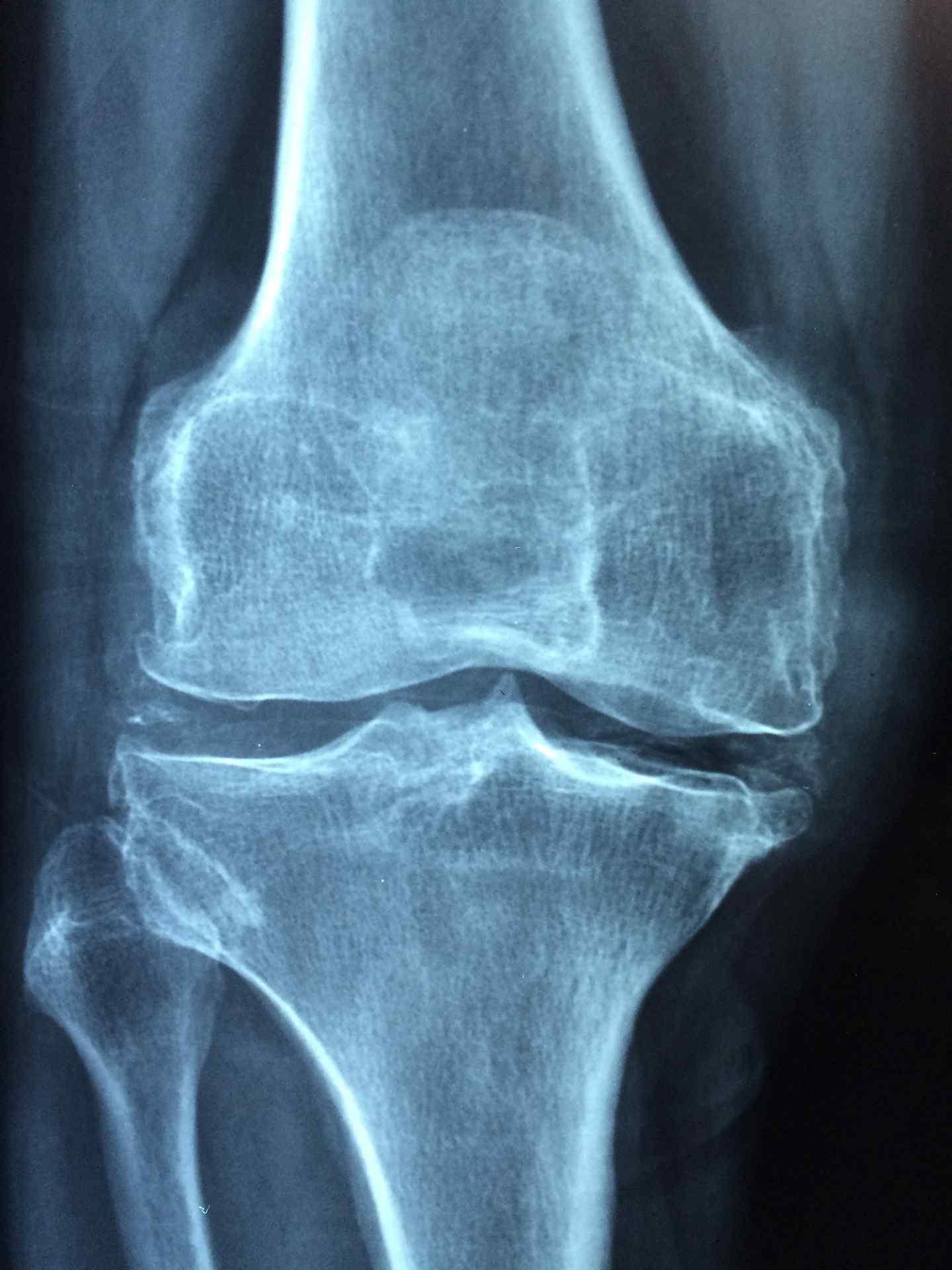 x-ray of a knee x-ray of a knee